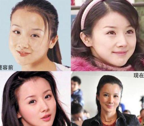 明星网红整容对比图,揭秘美丽背后的秘密